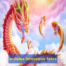 eritema infeccioso fotos